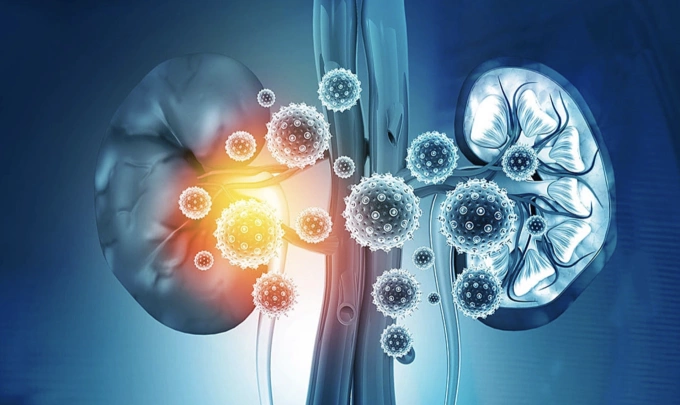 Minh họa tình trạng suy thận. Ảnh: Preferred Vascular Group