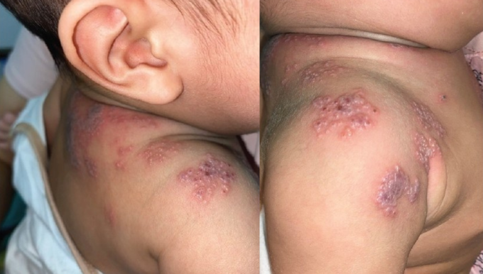 Các bóng nước zona thần kinh mọc từng đám ở vai và ngực bệnh nhi 5 tháng tuổi, điều trị tại Bệnh viện Da liễu Trung ương. Ảnh: Bệnh viện Da liễu Trung ương