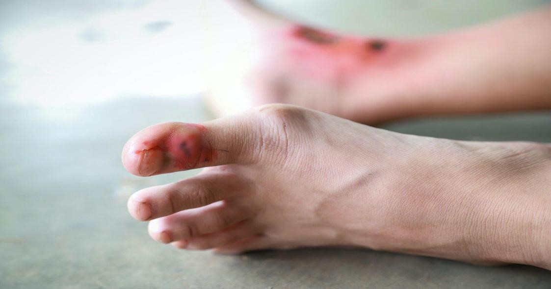 Bệnh nhân nam suýt mất mạng chỉ vì một vết xước nhỏ ở chân- Ảnh 1.