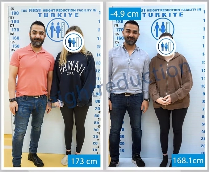 Height Reduction, phòng khám ở Thổ Nhĩ Kỳ, đăng ảnh bệnh nhân trước và sau phẫu thuật thu ngắn chi. Ảnh: Height Reduction