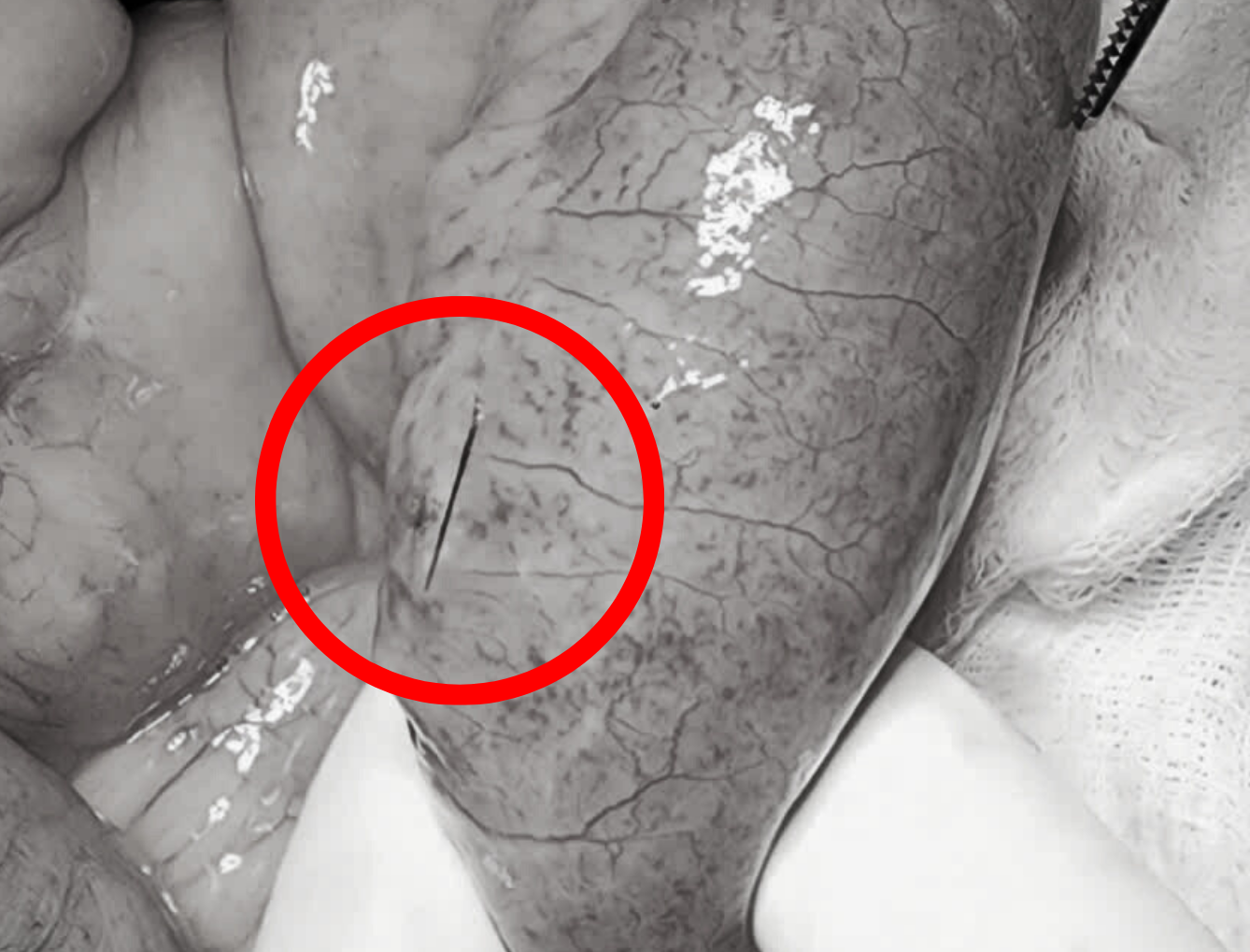 Xương cá dài 4cm đâm thủng ruột cụ ông - Ảnh 1.