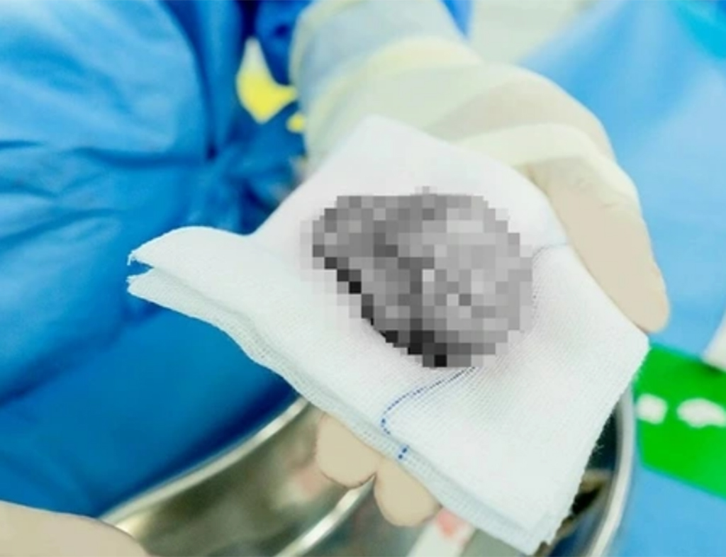 Đau nhiều ngày ở vùng bìu, đến bệnh viện khám phát hiện tinh hoàn hoại tử - Ảnh 1.