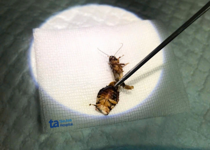 Bác sĩ gắp con gián ra khỏi tai ông Thái. Ảnh: Bệnh viện Đa khoa Tâm Anh