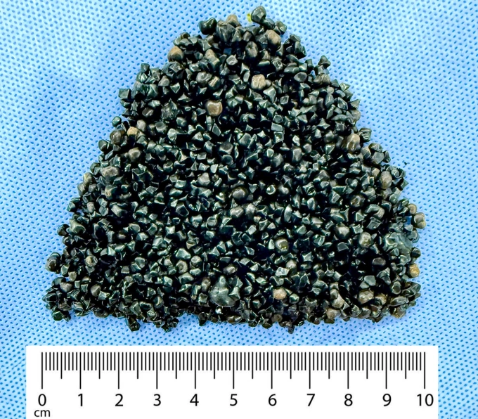 Hàng ngàn viên sỏi ở túi mật của bà Thu sau khi đưa ra ngoài. Ảnh: Bệnh viện Đa khoa Tâm Anh