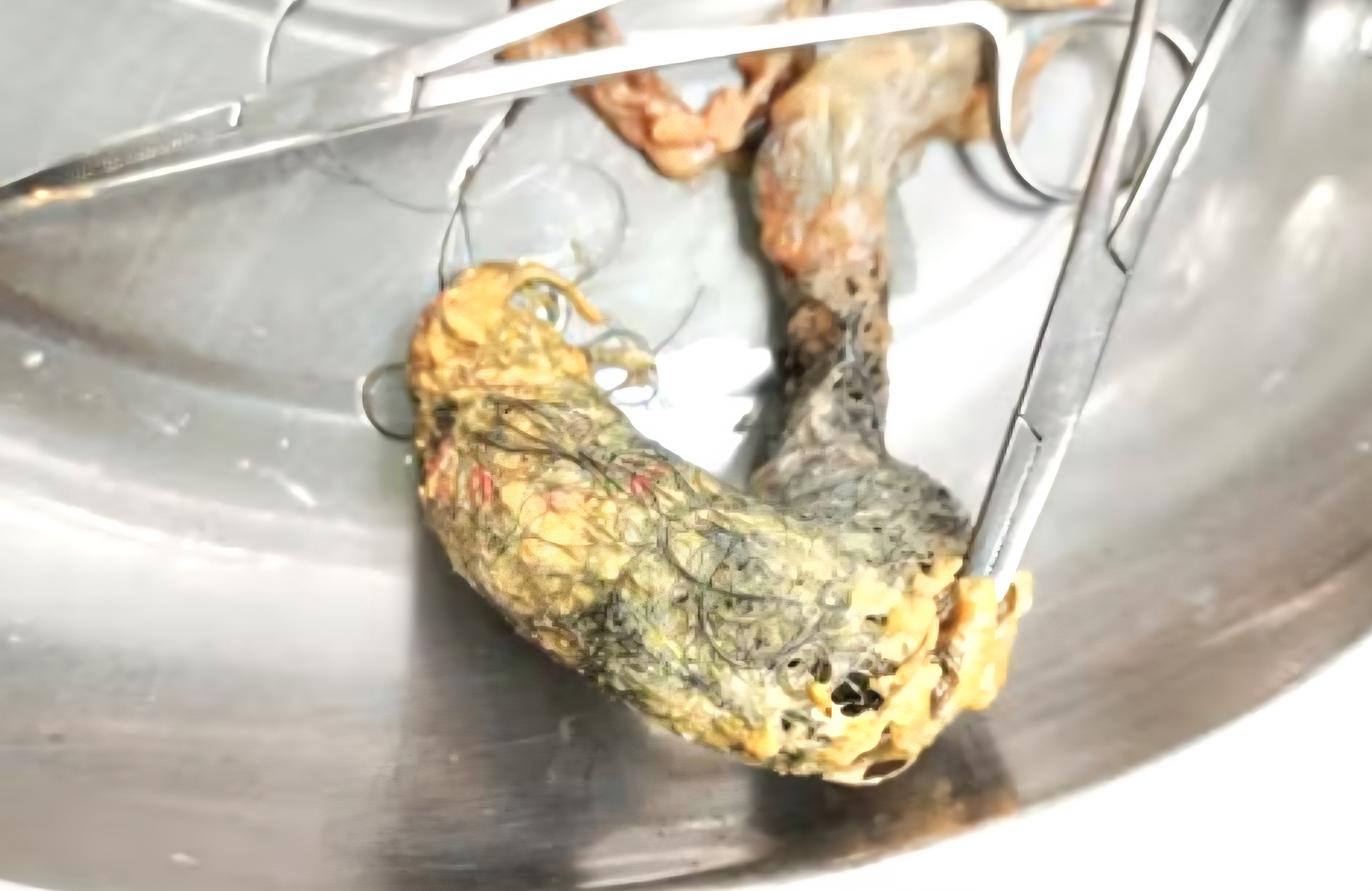 Hy hữu, búi tóc dài 12 cm trong ruột bé gái 4 tuổi ở TP.Cần Thơ - Ảnh 1.