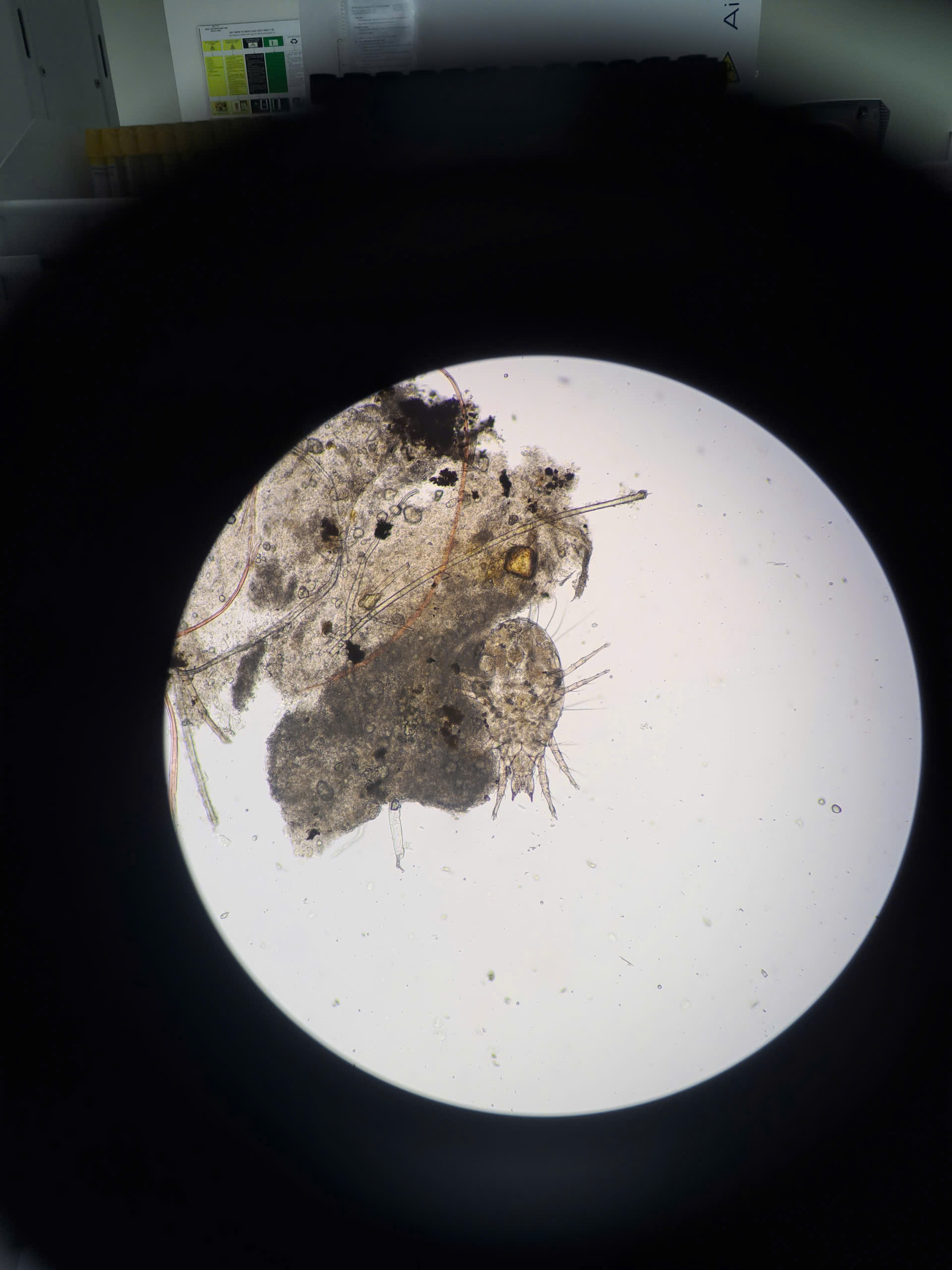 Ngứa mắt dai dẳng, cụ bà phát hiện rận mi- Ảnh 1.