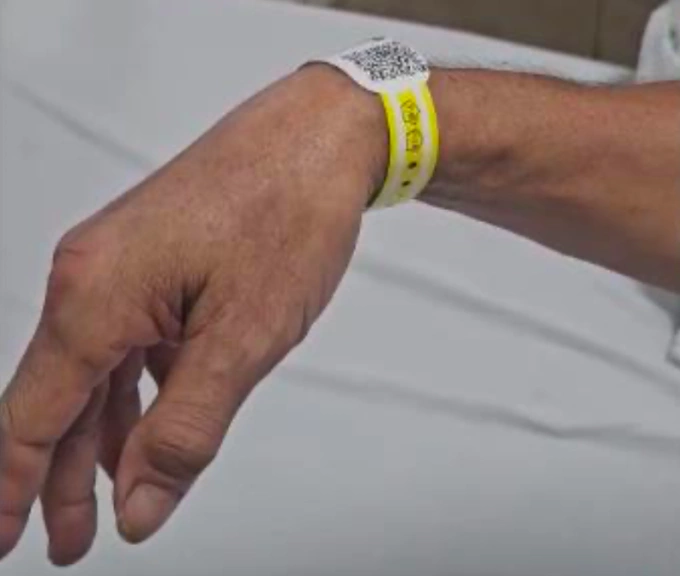 Hình ảnh tay người bệnh bị liệt dây thần kinh quay với biểu hiện điển hình là bàn tay rũ cổ cò. Ảnh: Bệnh viện cung cấp