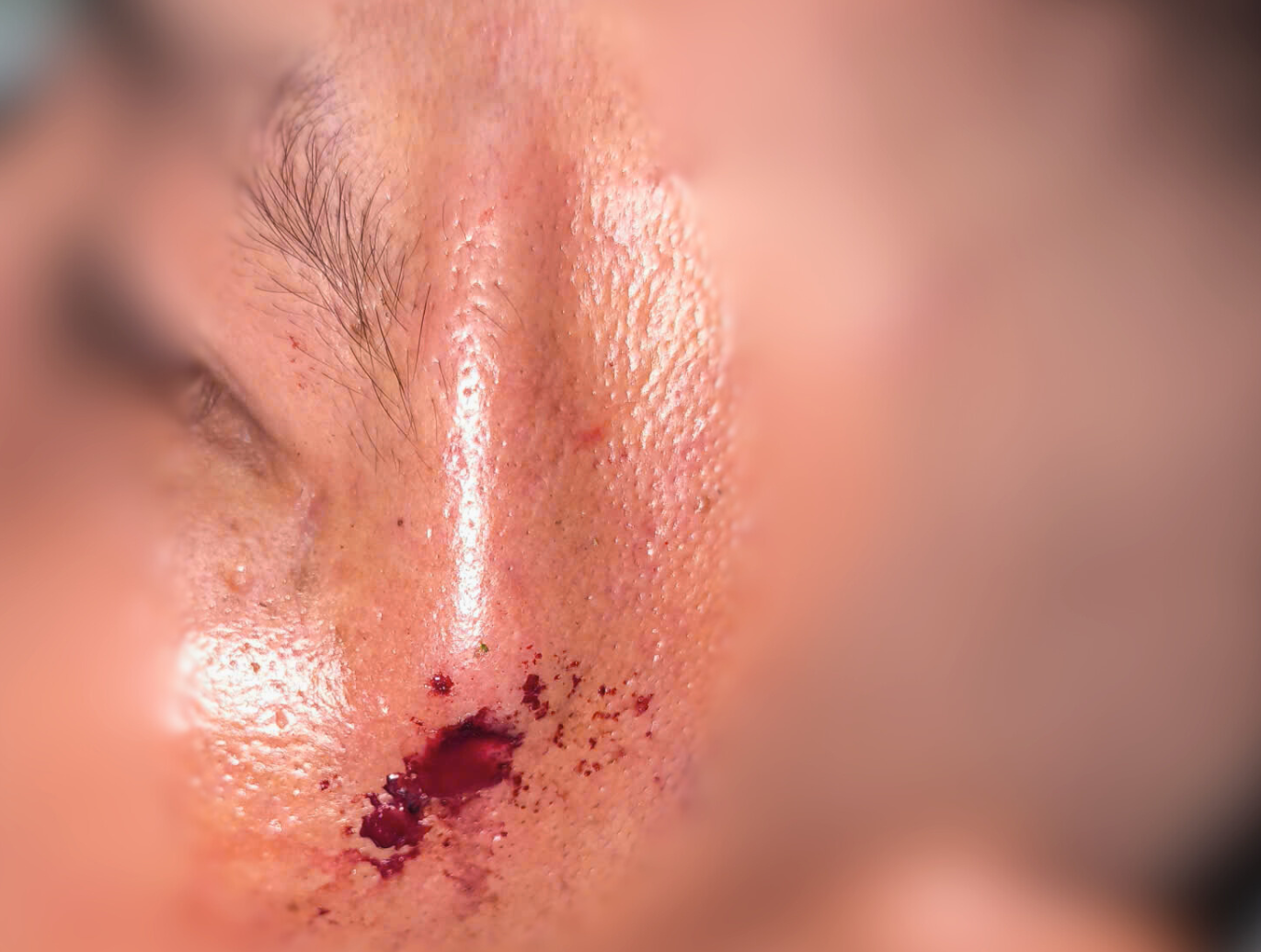 Người đàn ông nhập viện với nhánh cây đâm xuyên dưới da - Ảnh 1.