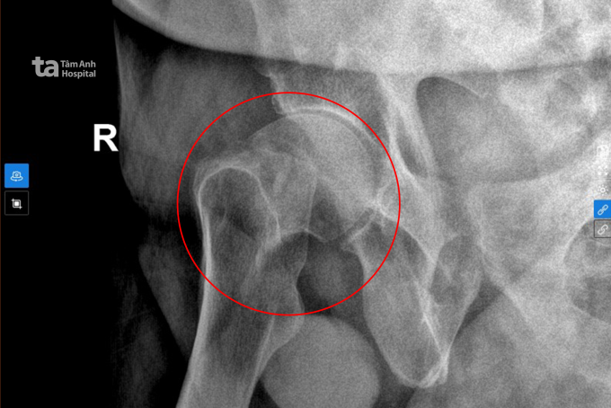 Kết quả chụp X-quang cho thấy vị trí gãy cổ xương đùi phải của người bệnh. Ảnh: Bệnh viện Đa khoa Tâm Anh