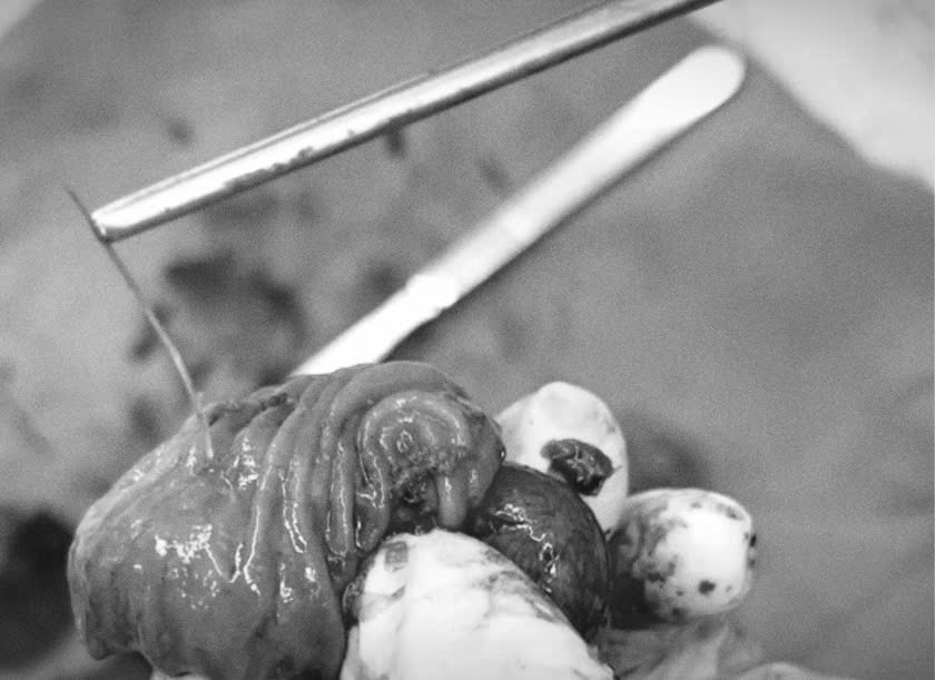 Từ ca mổ cấp cứu sau khi ăn bát bún cá: Bác sĩ chỉ ra 3 điều cần lưu ý- Ảnh 1.