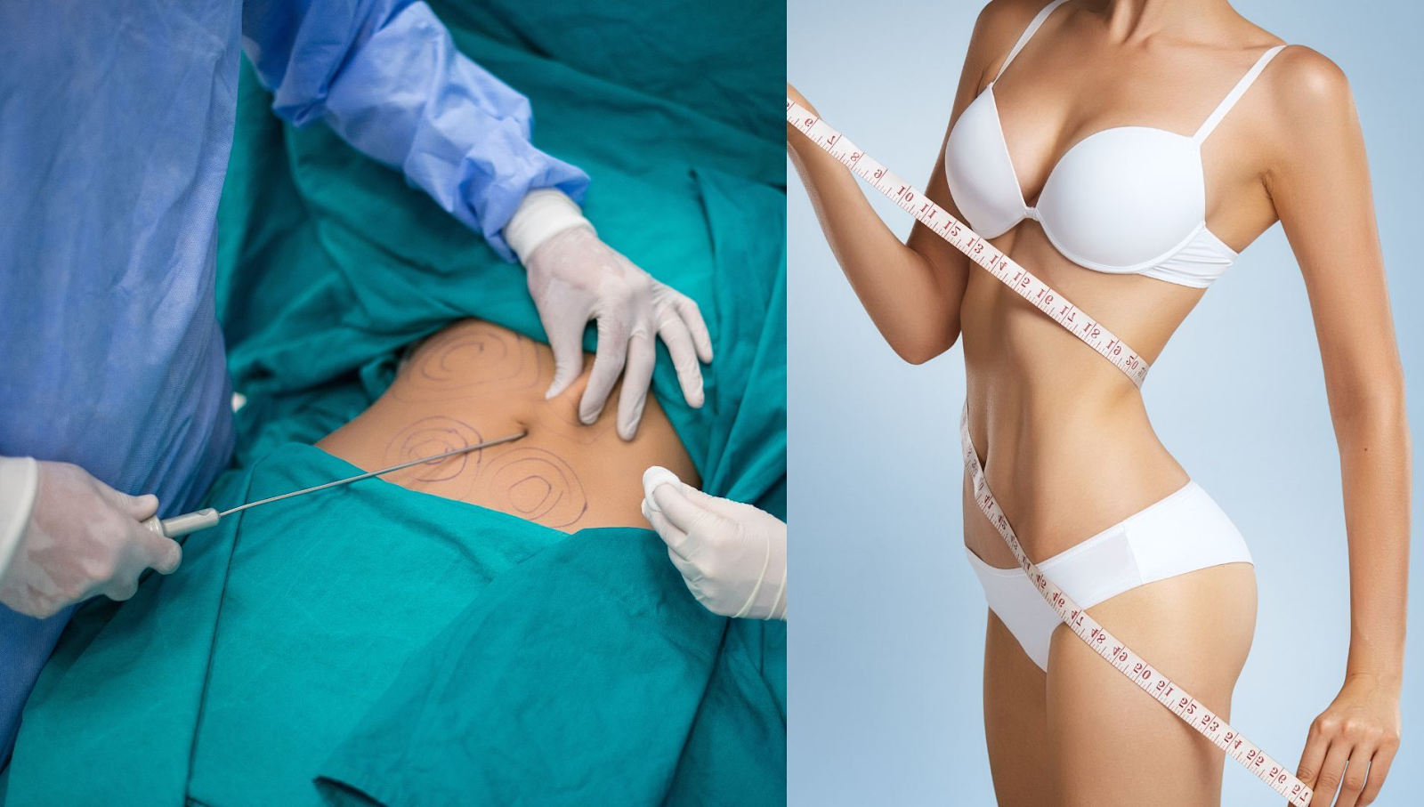Hút mỡ là phương pháp giúp loại bỏ mỡ thừa dưới da một cách hiệu quả và nhanh chóng