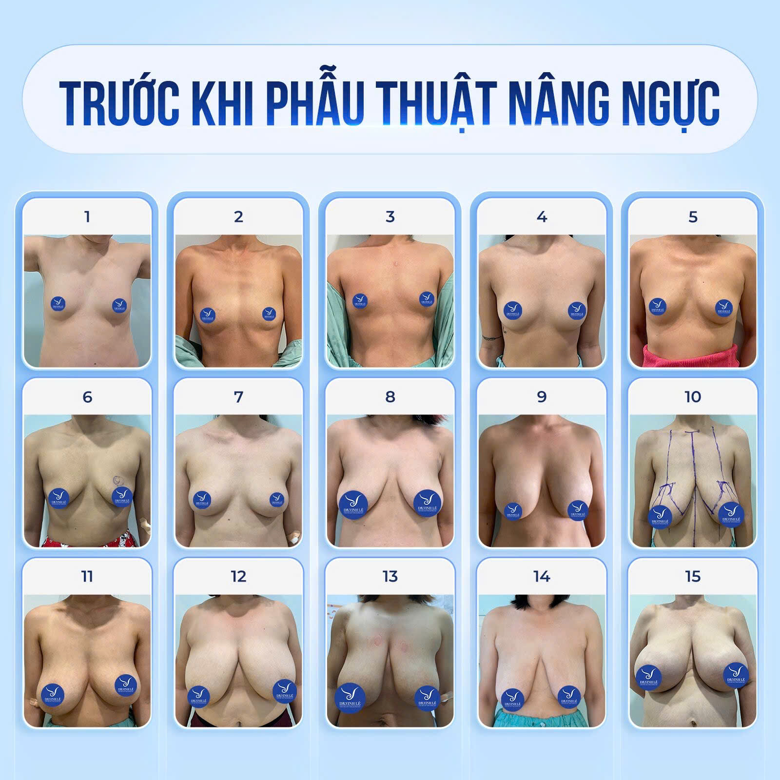 Ngực sa trễ hay còn gọi là ngực chảy xệ, nằm thấp hơn so với vị trí của lồng ngực.