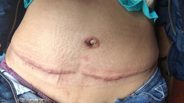Sẹo lồi ảnh hưởng đến thẩm mỹ, dễ gây ngứa, khó chịu, thậm chí đau rát kéo dài