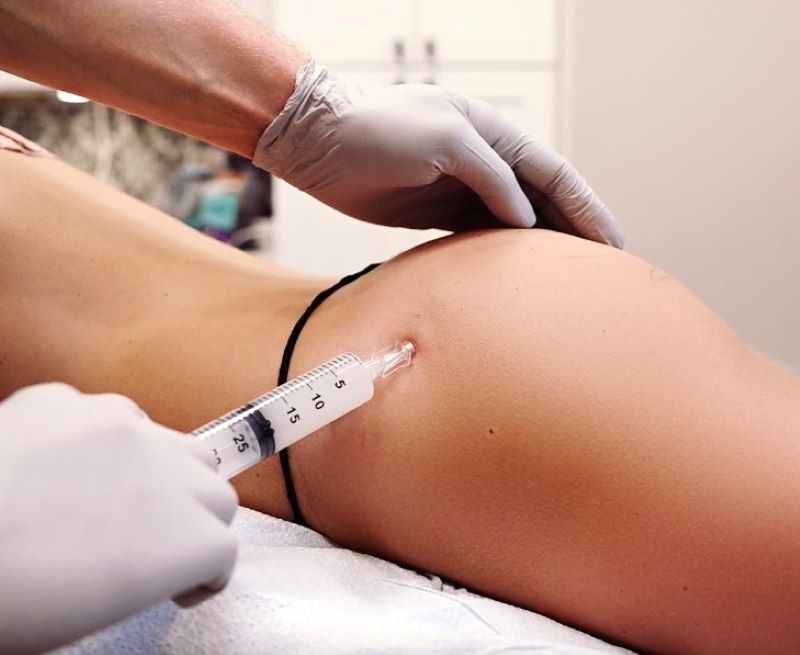 Tiêm Filler mông có thể gặp những biến chứng nào?