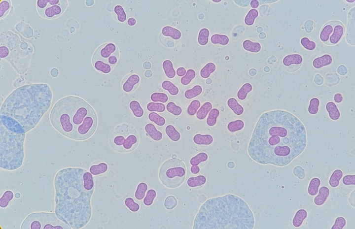 Hà Nội ghi nhận ca mắc não mô cầu là trẻ 11 tuổi, chưa tiêm vaccine- Ảnh 1.