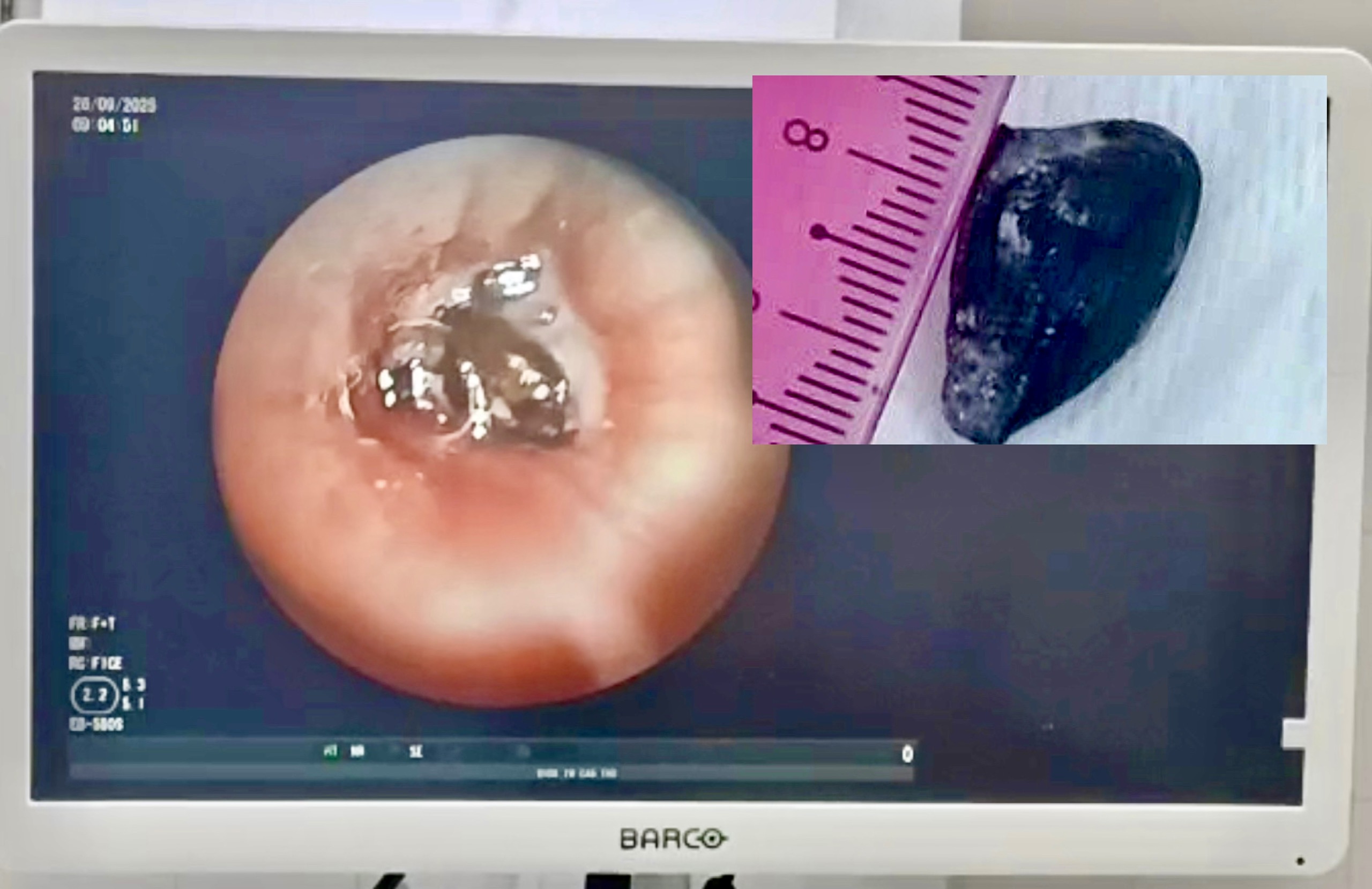 Ho dai dẳng 10 năm vì hạt sapôchê kẹt trong phế quản - Ảnh 1.