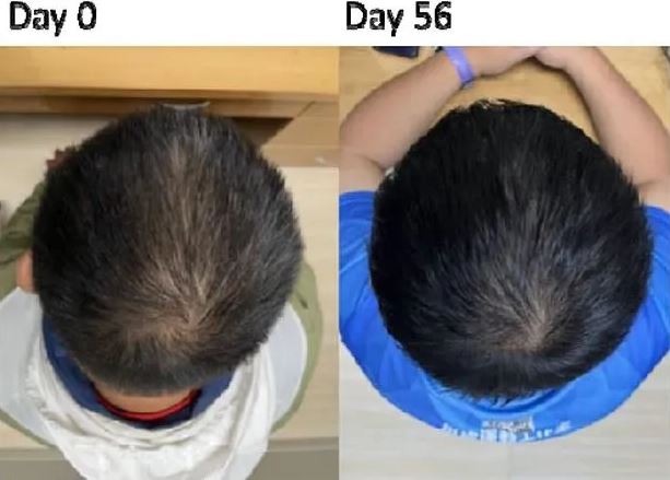 Tìm ra phương pháp chữa hói đầu, kích thích mọc tóc cực tốt – sau 8 tuần là cải thiện rõ- Ảnh 1.