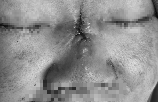 Tốn 65 triệu cho chiếc mũi hoại tử 'cháy xém' vì tin thầy phong thủy đổi vận - Ảnh 1.