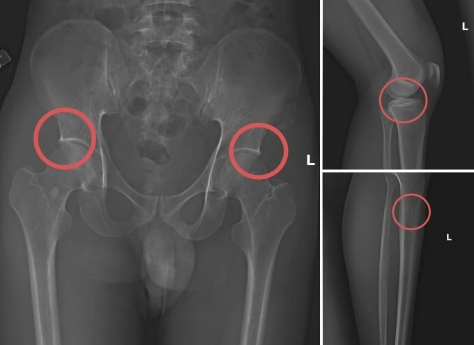 Vụ tự đục gãy xương để chiếm đoạt hơn 6 tỷ đồng tiền bảo hiểm: Bác sĩ thốt lên "quá tàn nhẫn”