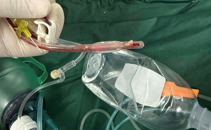 Bé gái 3 tuổi tử vong sau khi sặc thức ăn tại lớp mẫu giáo ở TPHCM