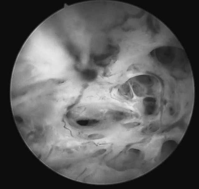 Cố giữ "cái ngàn vàng", người phụ nữ 30 tuổi nhận kết quả ung thư niêm mạc tử cung