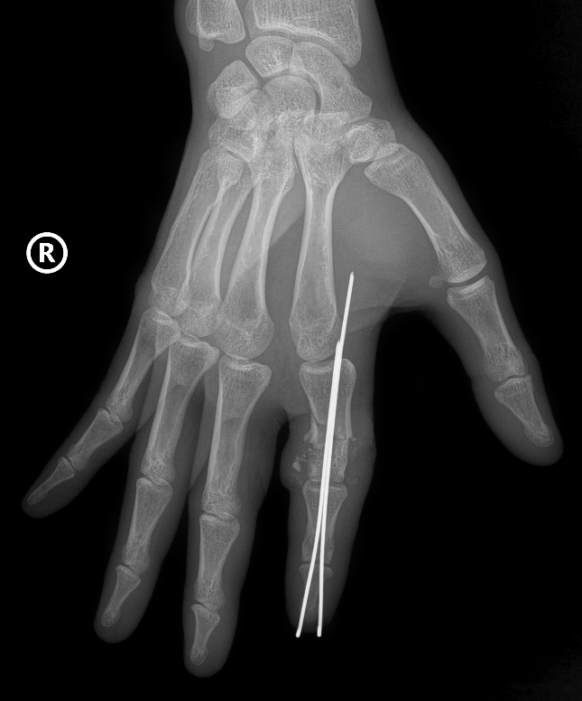 Cứu sống ngón tay thủy thủ bị đứt rời sau 25 giờ- Ảnh 1.