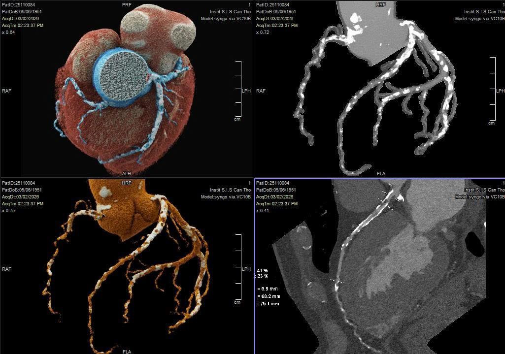 Bệnh nhân thoát nguy cơ ‘thượng mã phong’ nhờ chia sẻ chuyện phòng the