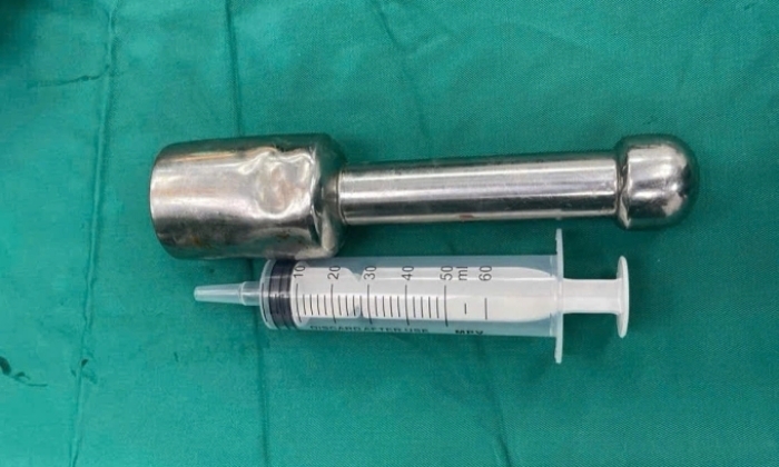 Chiếc chày 18 cm mắc kẹt trong trực tràng nam sinh 15 tuổi