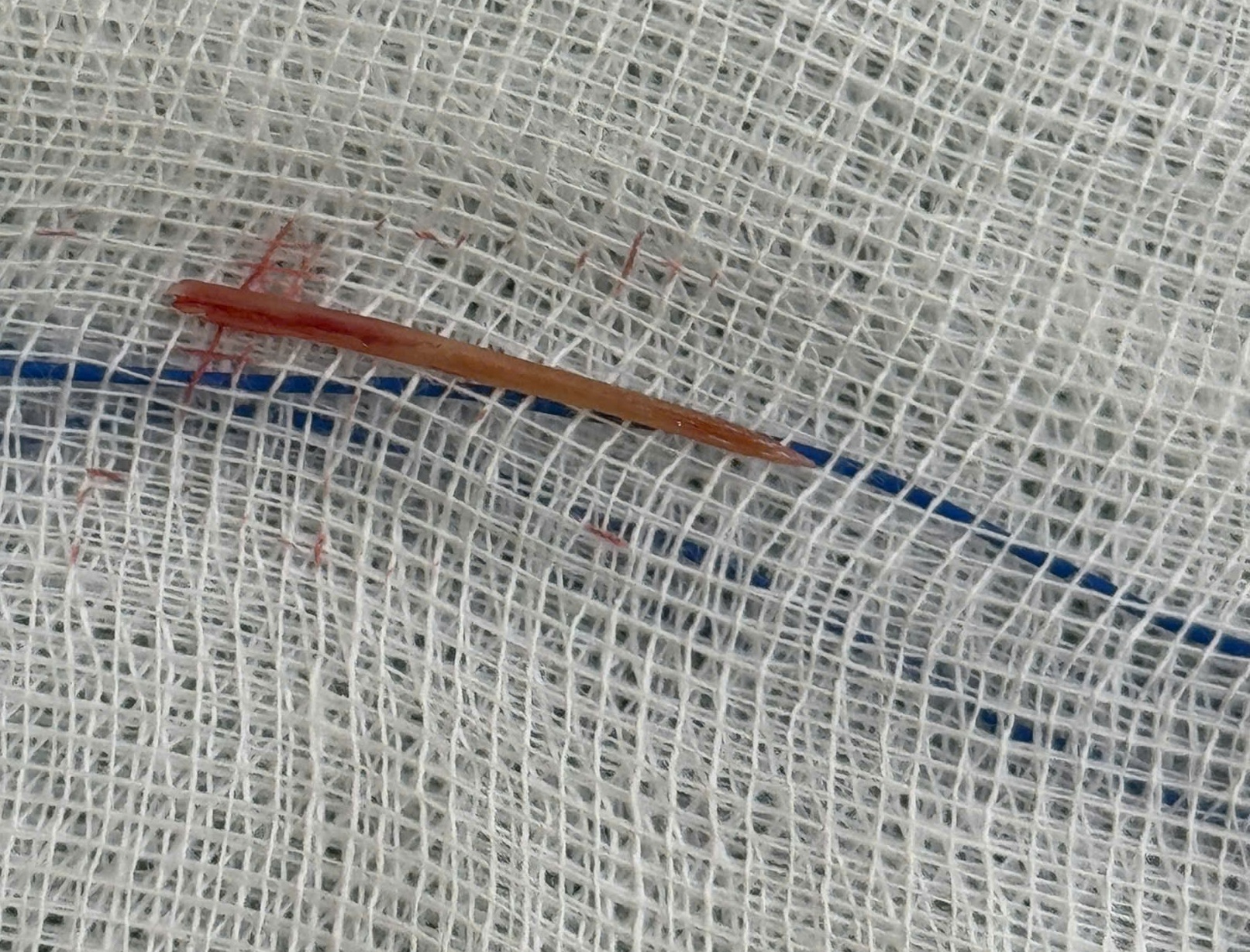 Đau bụng 5 ngày, đi khám phát hiện xương cá đâm xuyên ruột non - Ảnh 1.