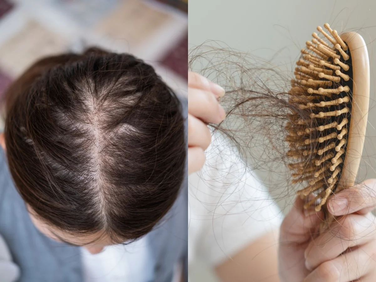 Đừng chỉ ăn trứng luộc để ngừa tóc rụng!