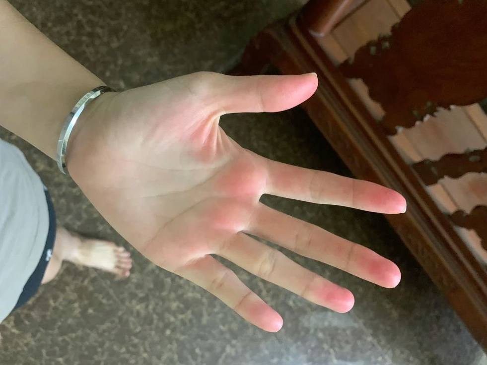 Nếu có đủ 5 thứ trên bàn tay thì xin chúc mừng! Gan của bạn khả năng cao vẫn còn rất khỏe
